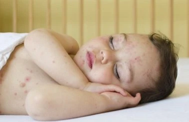 Сыпь при ОРЗ у ребенка: почему она появляется и нужно ли с ней бороться?